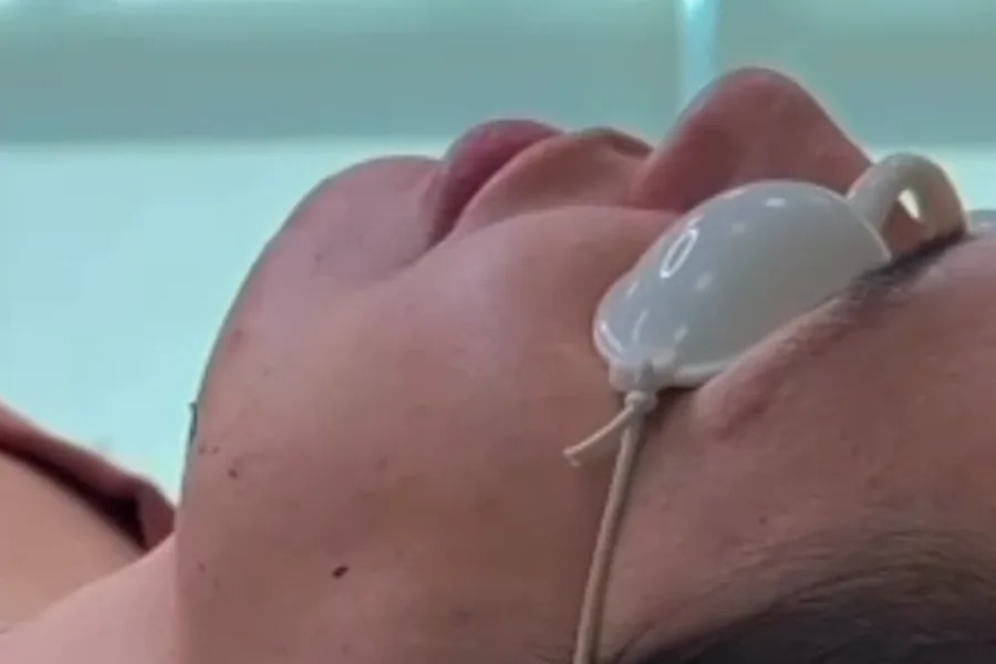 Black Peel — máscara de carvão aplicada com laser