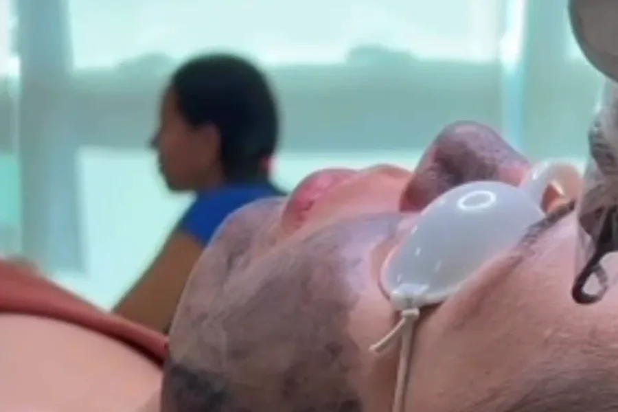 Black Peel — procedimento facial a laser