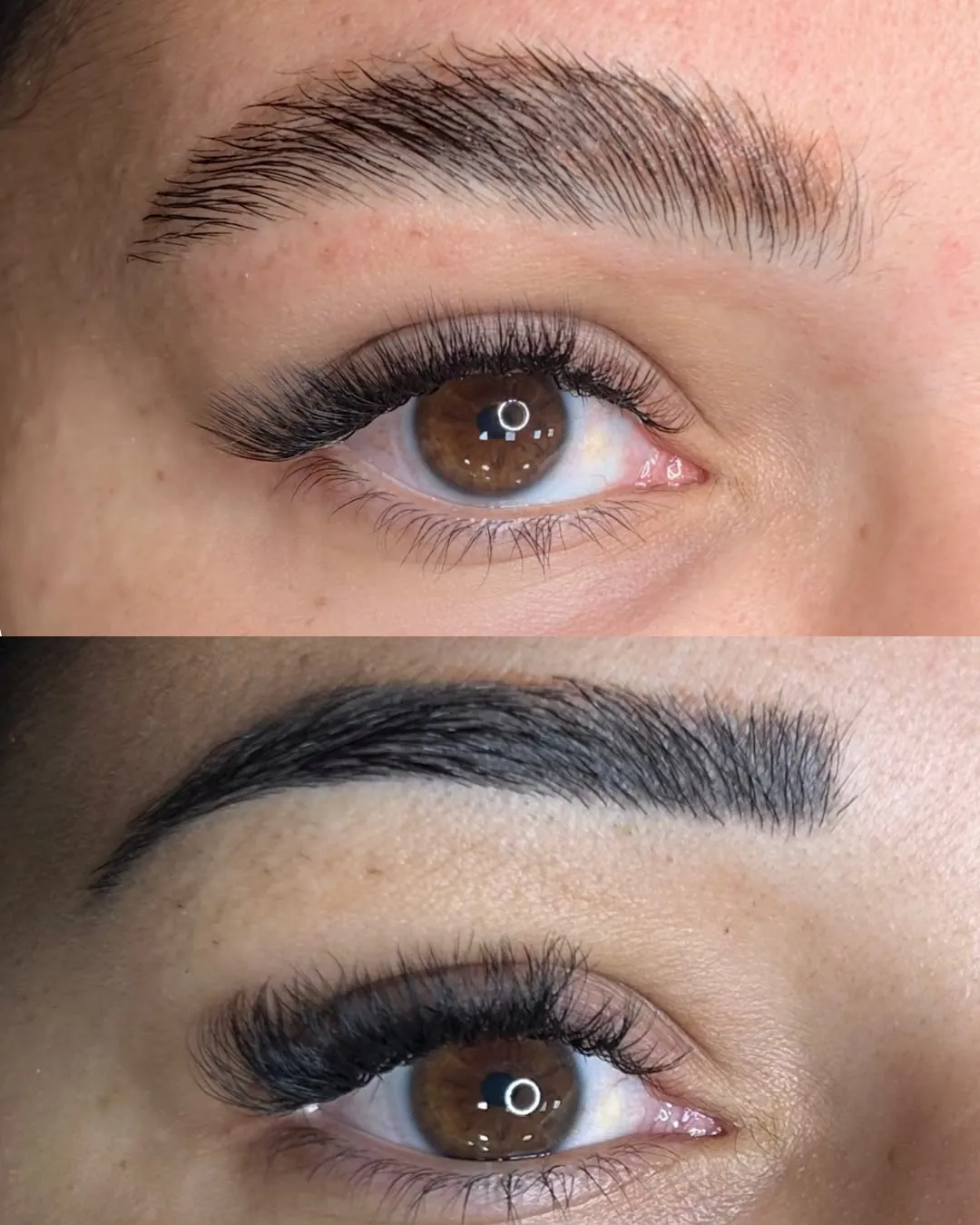 Despigmentação de sobrancelha a laser — antes e depois
