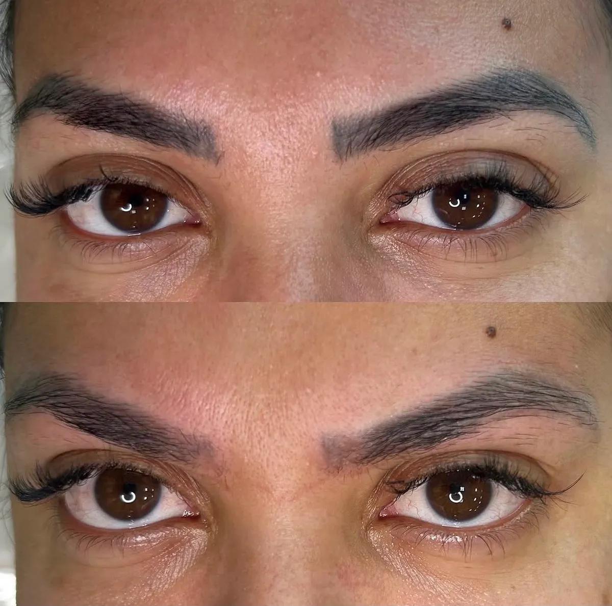 Remoção/clareamento a laser de micropigmentação de sobrancelha — antes e depois