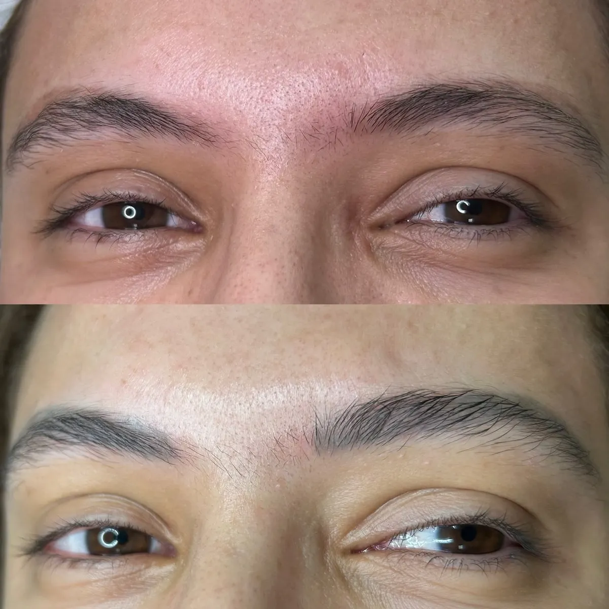 Clareamento a laser de micropigmentação de sobrancelha — antes e depois
