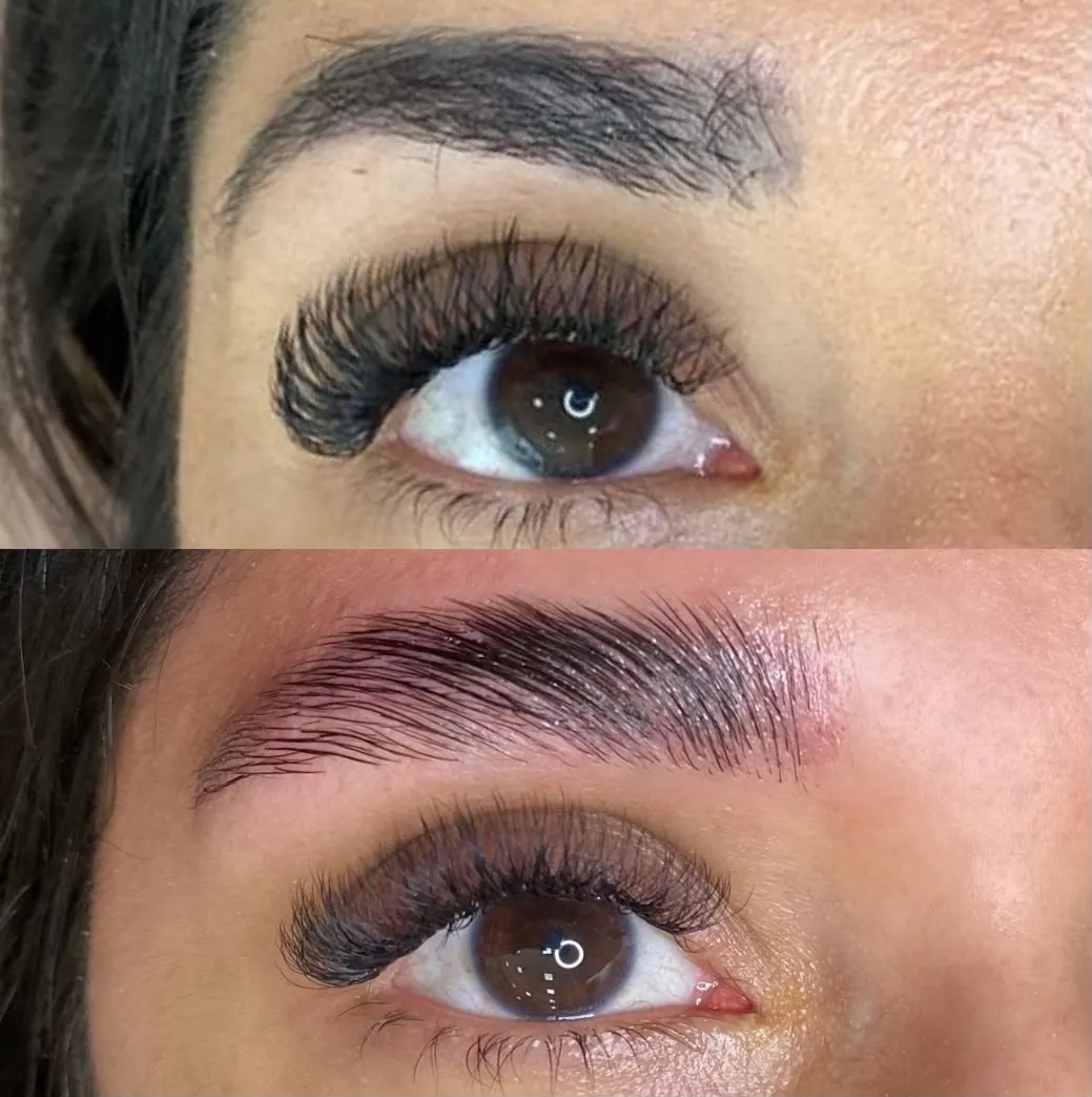 Clareamento a laser de micropigmentação de sobrancelha — antes e depois