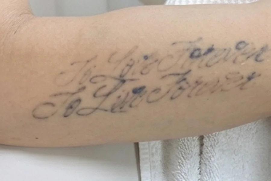 Tatuagem clareando a laser