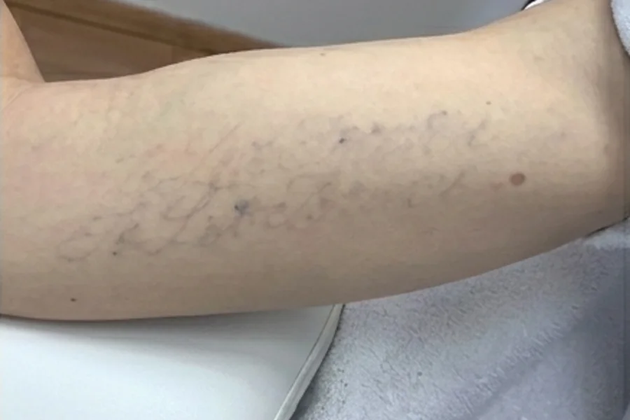 Tatuagem clareando a laser
