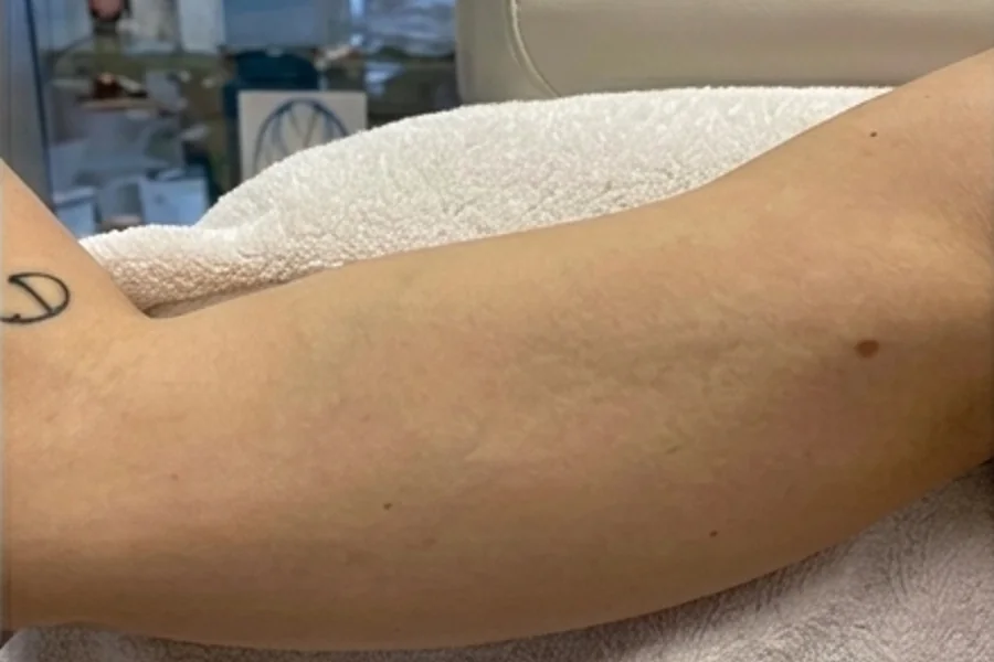 Tatuagem quase removida a laser