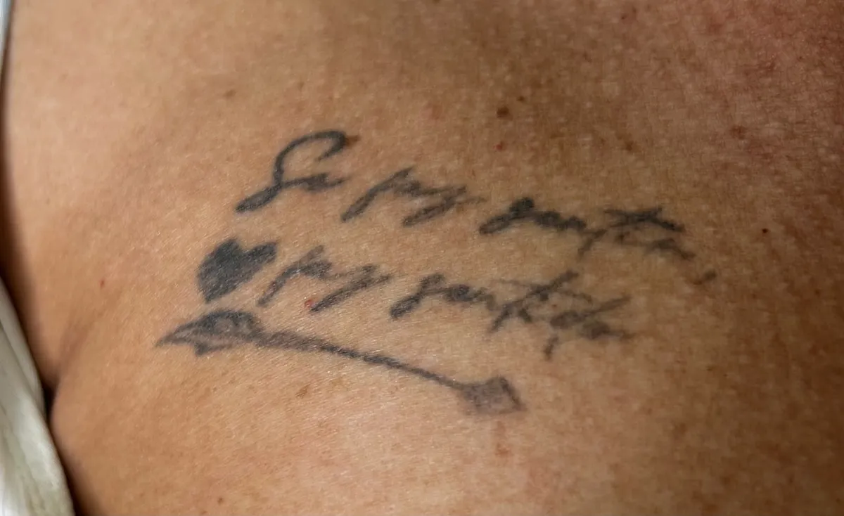 Remoção a laser de tatuagem escrita nas costas — em tratamento
