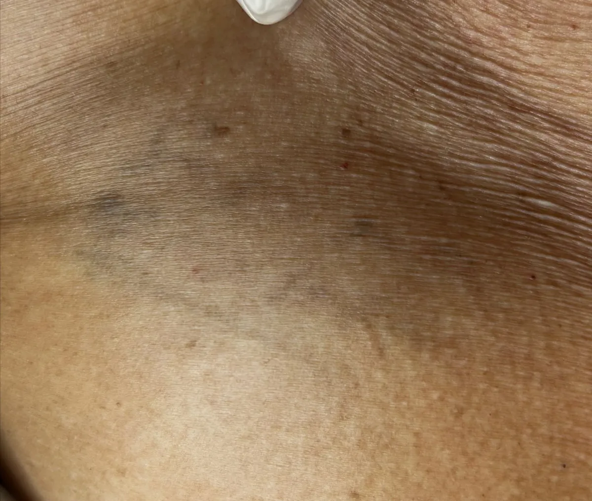 Remoção a laser de tatuagem — resultado avançado, pele quase limpa