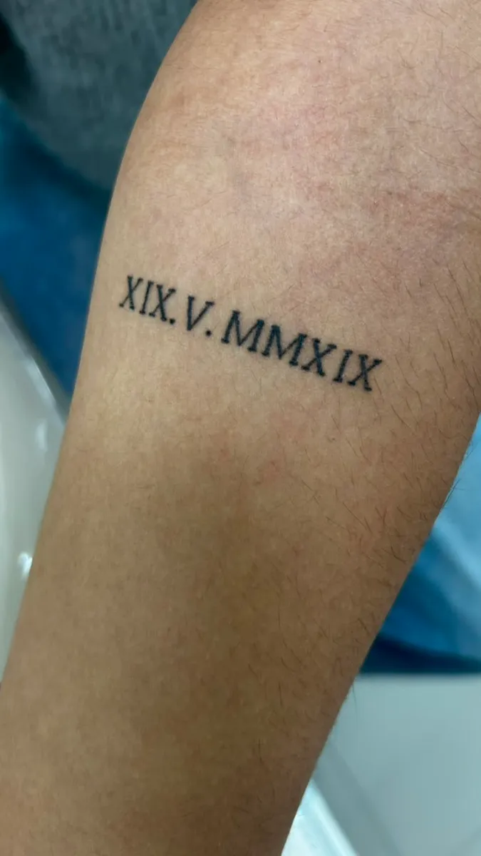 Remoção a laser de tatuagem de números romanos — início do tratamento