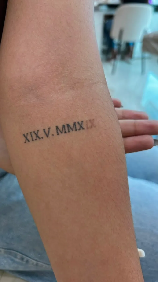 Remoção a laser de tatuagem de números romanos — traço clareado